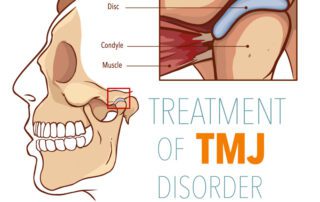 Treat TMJ Disorder