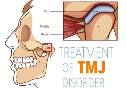 Can TMJ Be Linked to Stress and Anxiety?