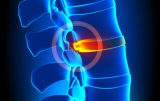 Bulging Disc