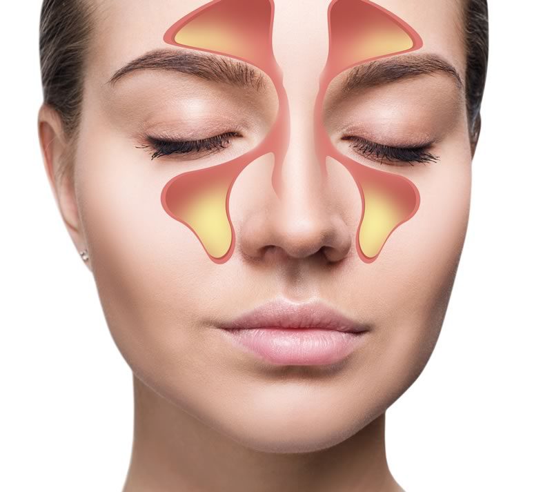 Sinus Headache Sinus Headache
